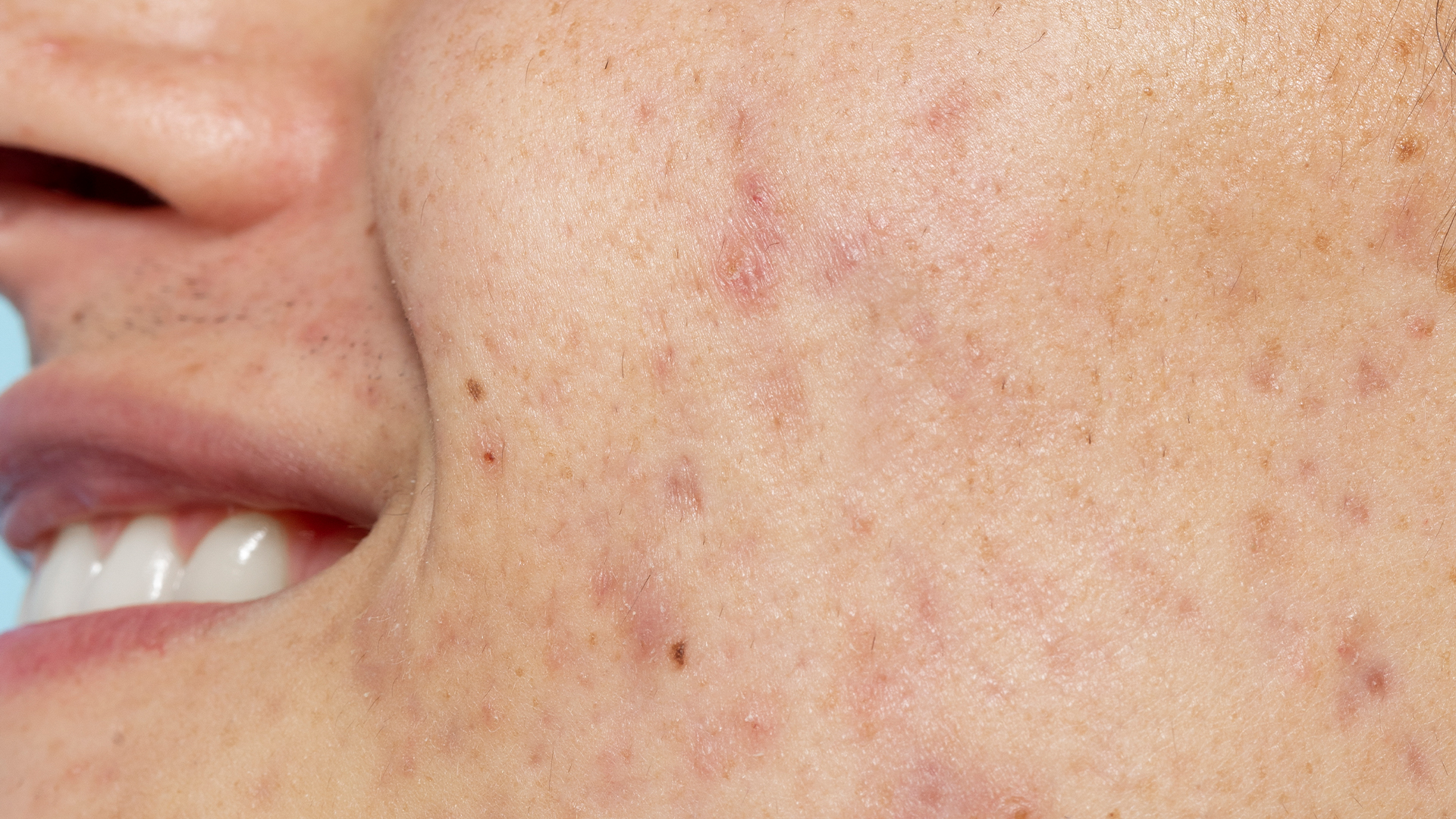 Acne adulta e disfunção hepática: o que o intestino e o fígado têm a ver com inflamação cutânea?